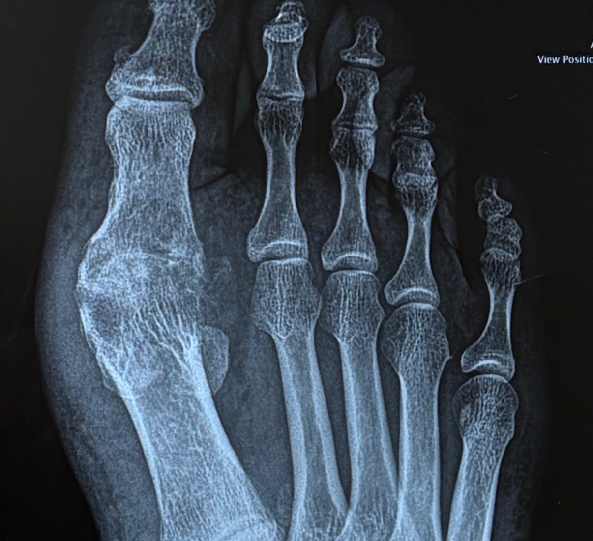 AP foot x-ray