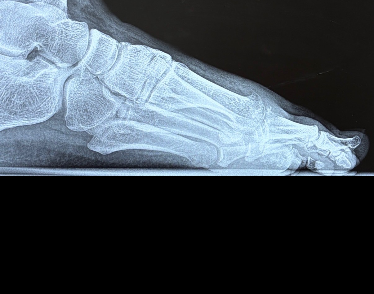 Lateral foot x-ray